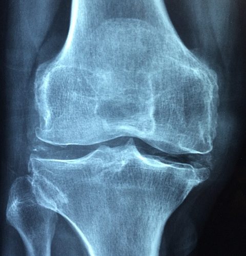 Fizjoterapia i rehabilitacja: Stara kontuzja kolana moze odezwać sią bólem kostki